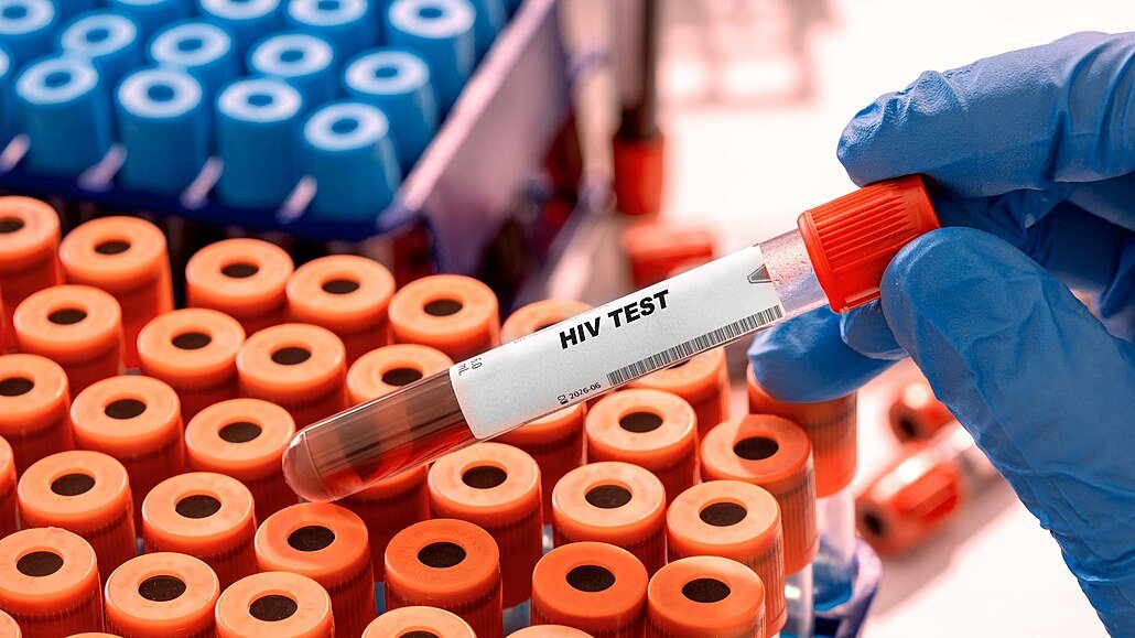 HIV v Česku dál přibývá. Případy nejsou jen ve velkých městech, týkají se i Hradeckého kraje